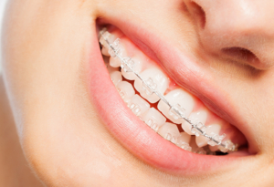 Happy smile of young woman with clear dental braces