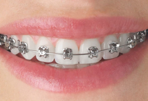 Metal Braces